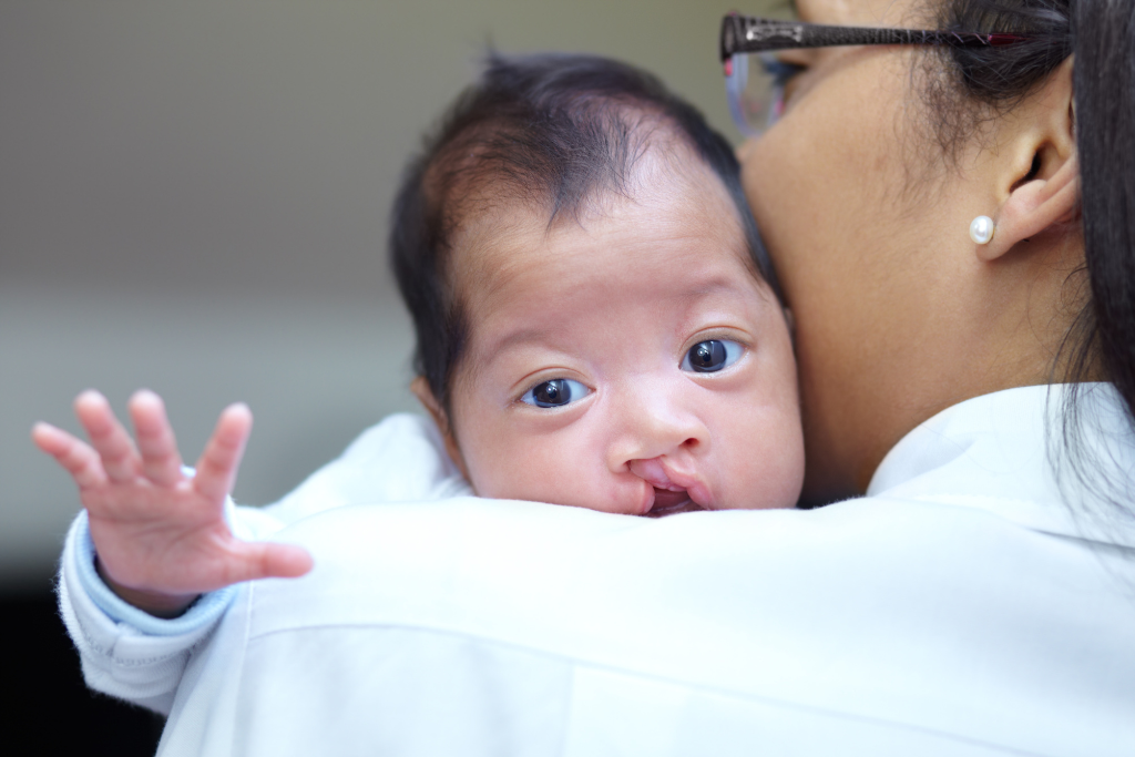 Bec de Lièvre : Causes, Traitement et Chirurgie