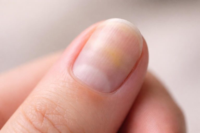 Mélanome Ongle Débutant Photos : Reconnaître les Premiers Signes