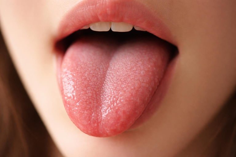 Papillite Linguale : Causes, Symptômes et Traitement